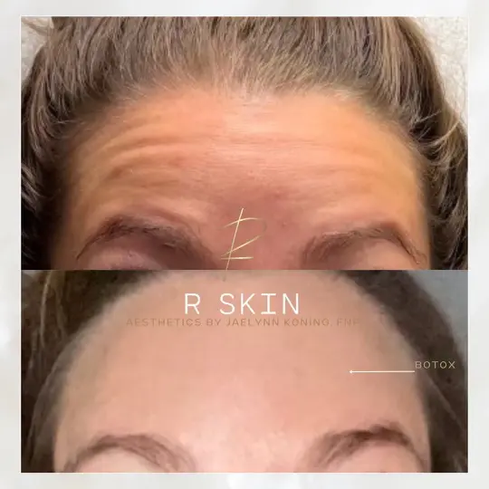 R Skin Aesthetics by Raquel brow lift result — Birmingham, MI