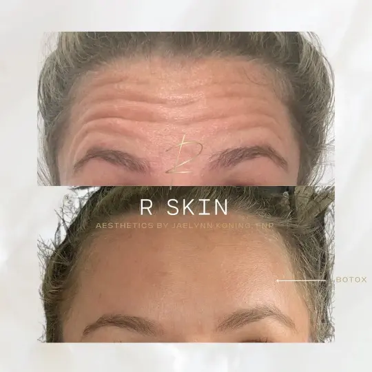 Botox result at R Skin Aesthetics by Raquel in Birmingham, MI