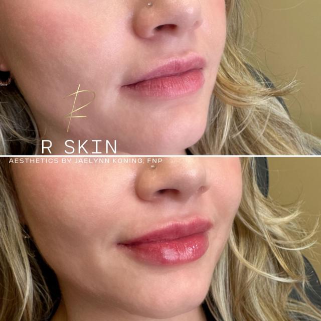 Dermal Fillers result at R Skin Aesthetics by Raquel in Birmingham, MI