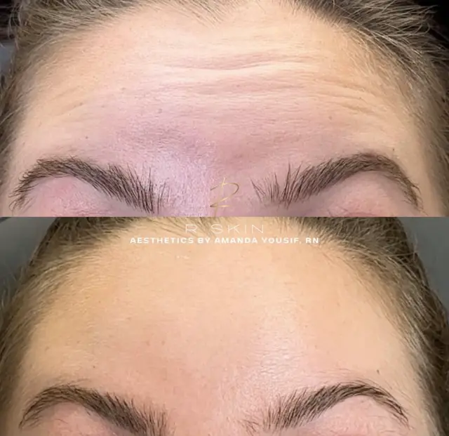 Brow Lift result at R Skin Aesthetics by Raquel in Birmingham, MI