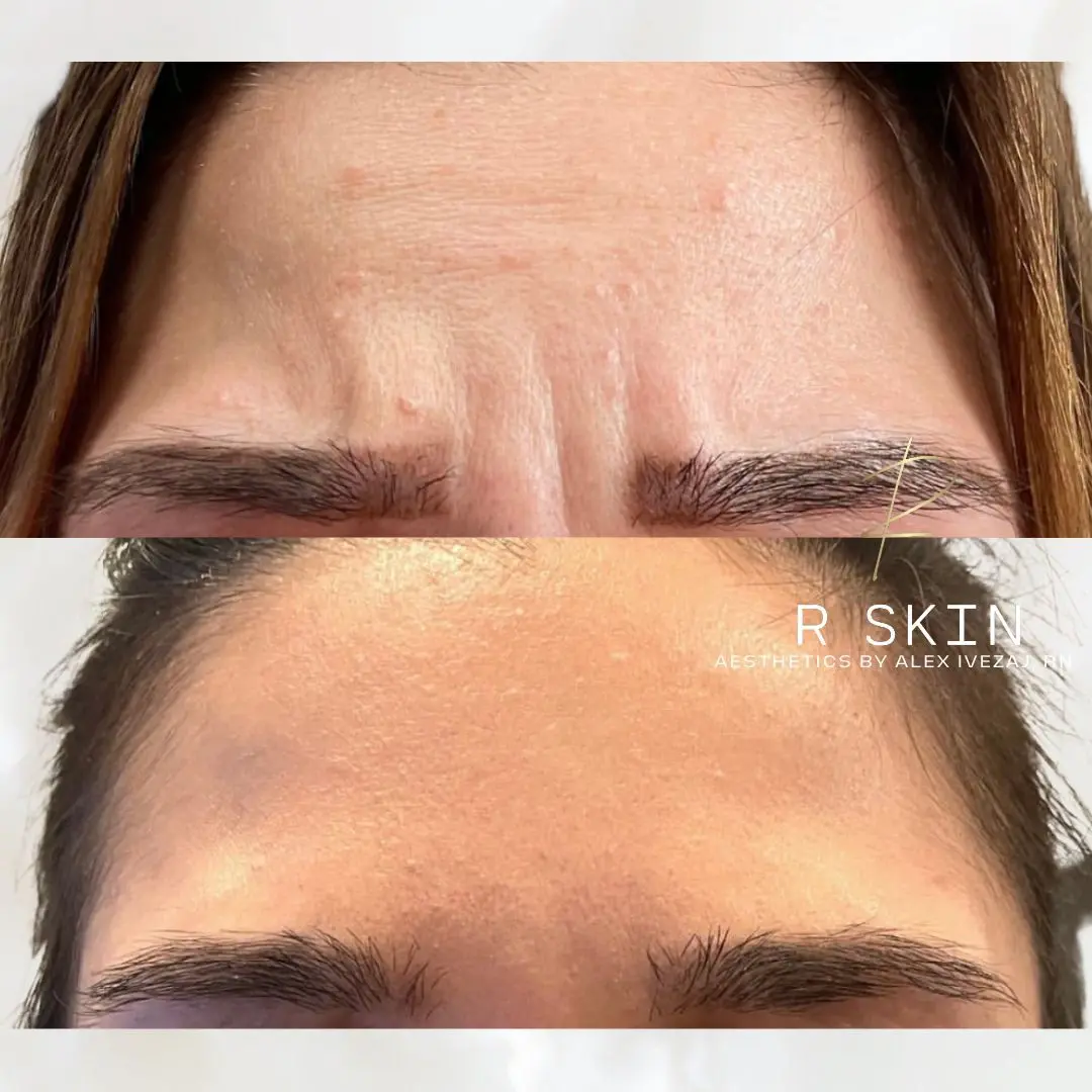 R Skin Aesthetics by Raquel botox result — Birmingham, MI