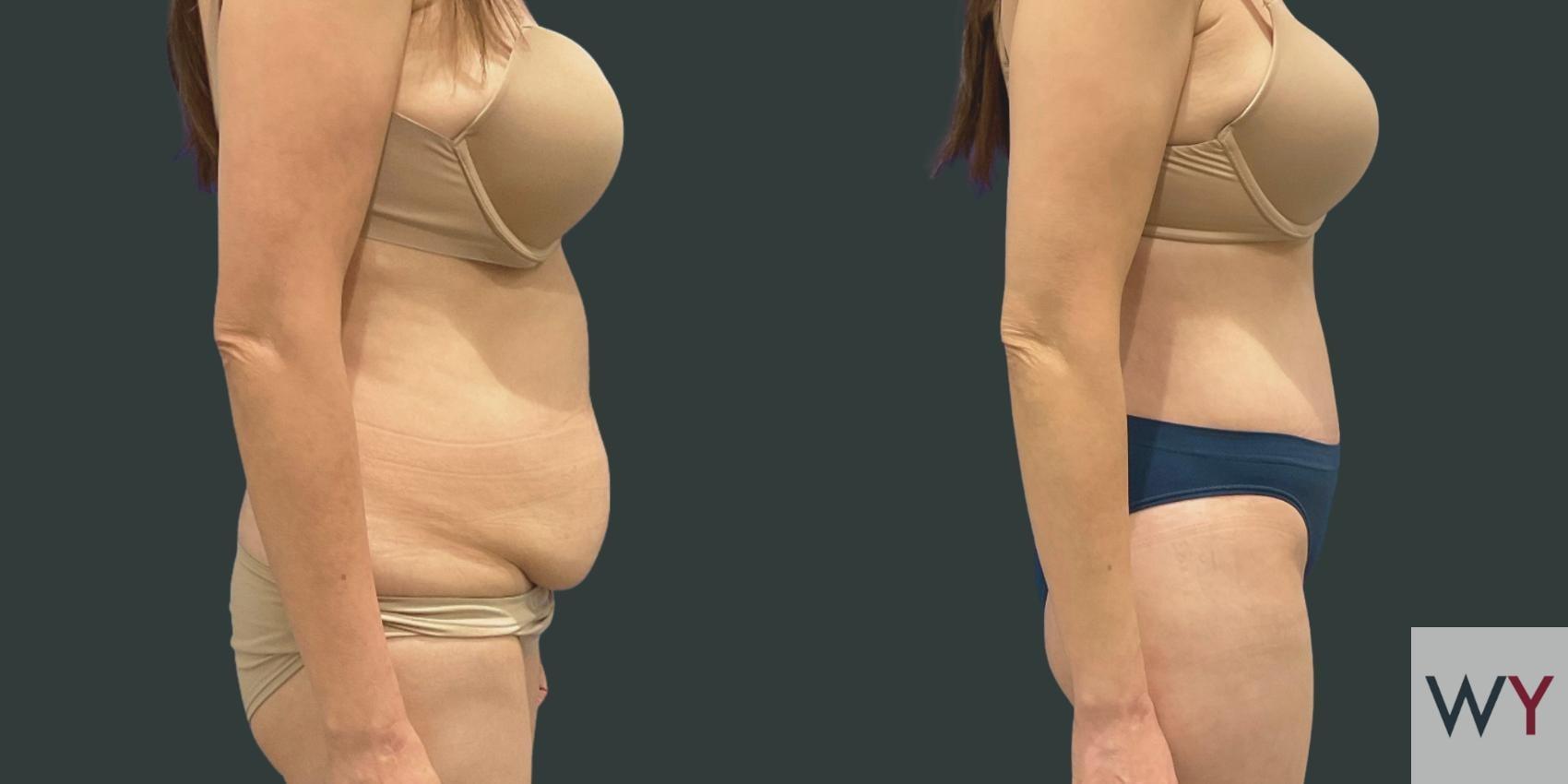 Wayne I. Yamahata, MD tummy tuck result — Sacramento, CA