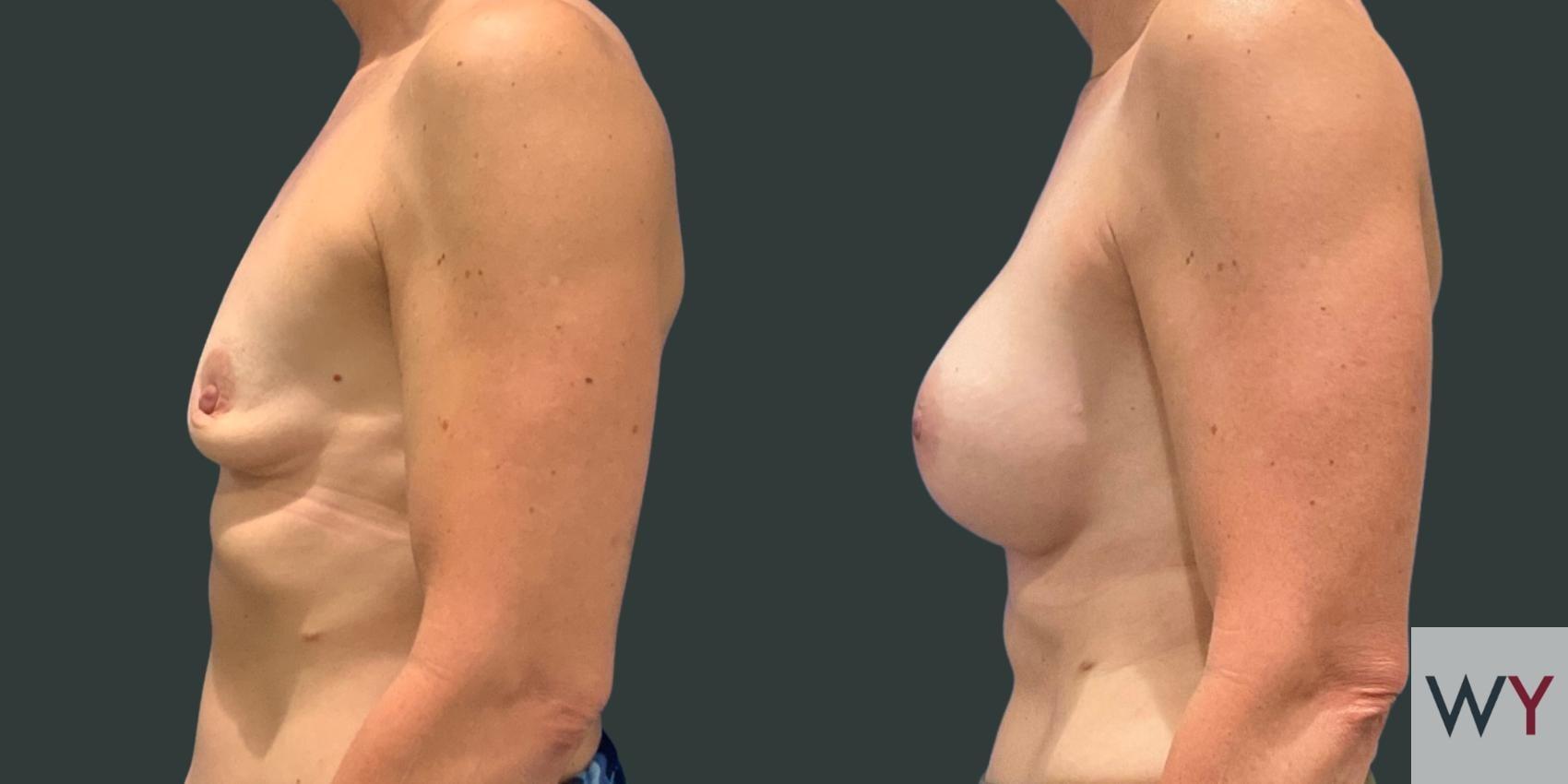 Wayne I. Yamahata, MD breast augmentation result — Sacramento, CA