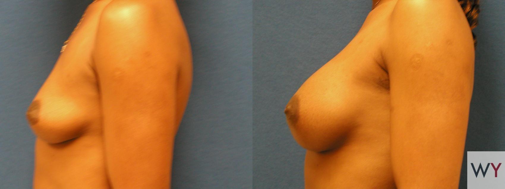Wayne I. Yamahata, MD breast augmentation result — Sacramento, CA