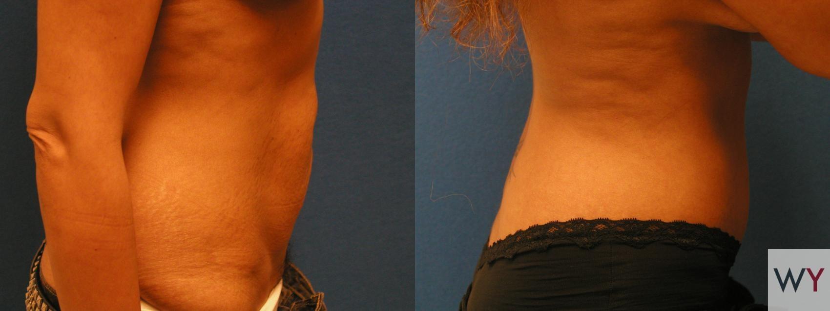 Wayne I. Yamahata, MD tummy tuck result — Sacramento, CA