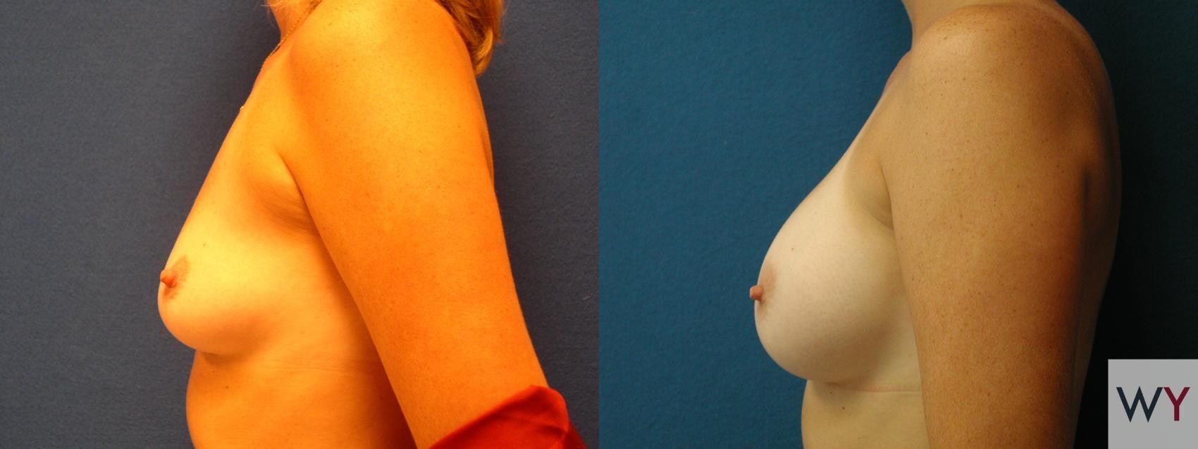 Wayne I. Yamahata, MD breast augmentation result — Sacramento, CA