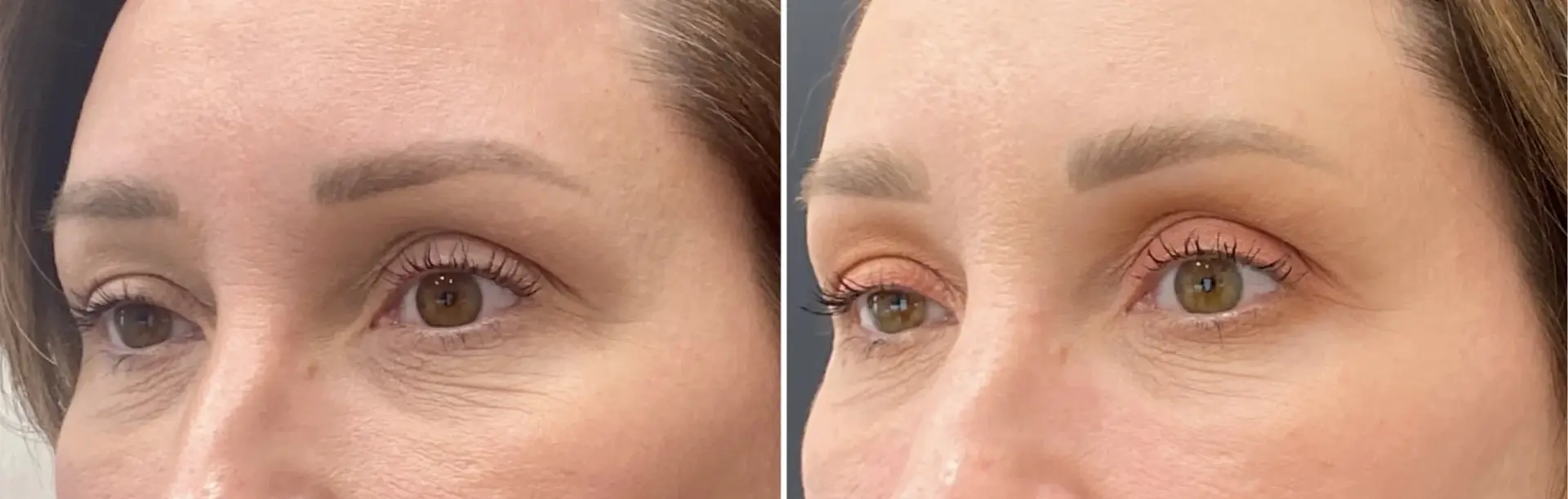 Dr. Ann Aesthetics result — Edina, MN