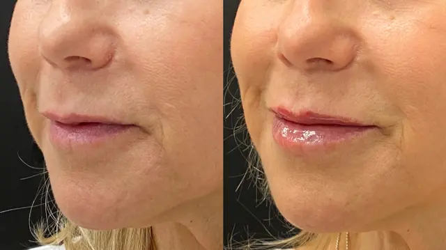 Lip Filler result at Dr. Ann Aesthetics in Edina, MN