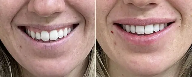 Lip Filler result at Dr. Ann Aesthetics in Edina, MN
