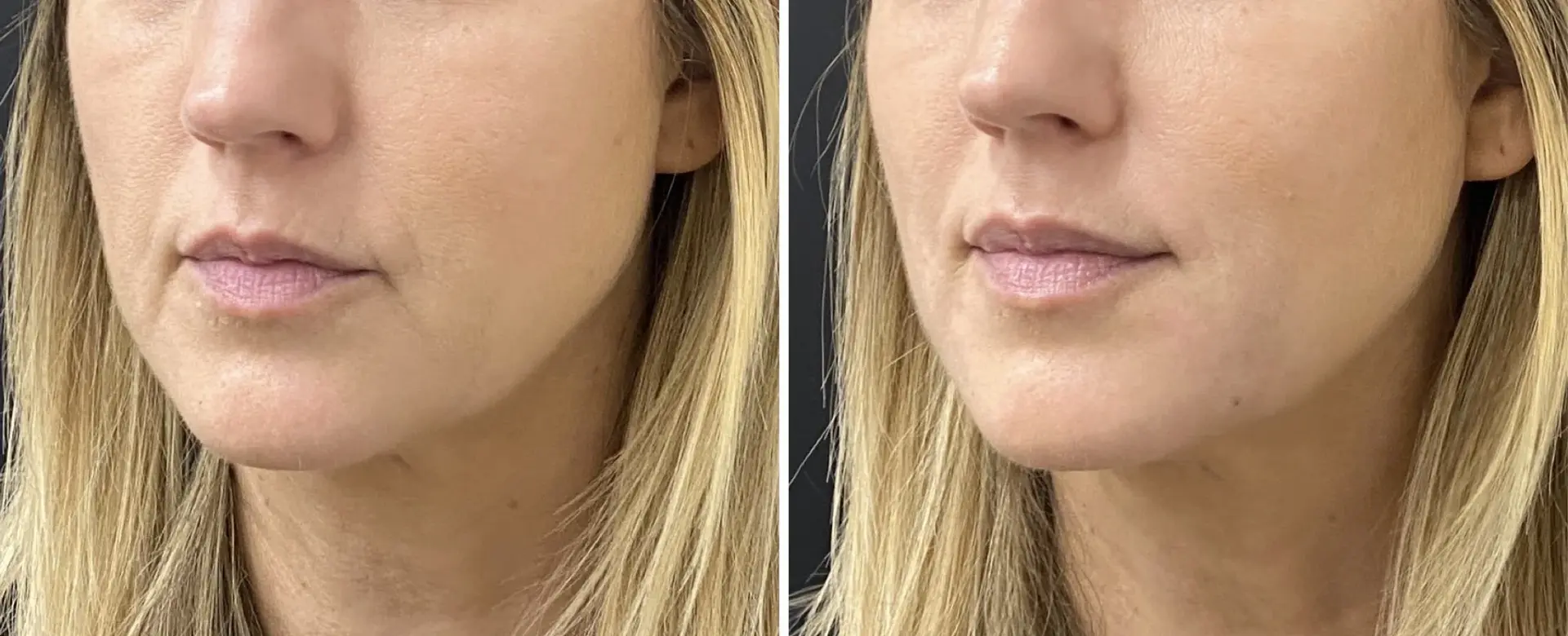 Dr. Ann Aesthetics result — Edina, MN