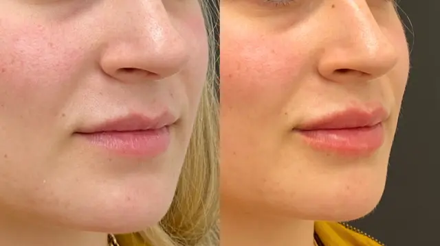 Lip Filler result at Dr. Ann Aesthetics in Edina, MN