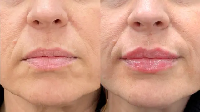 Lip Filler result at Dr. Ann Aesthetics in Edina, MN
