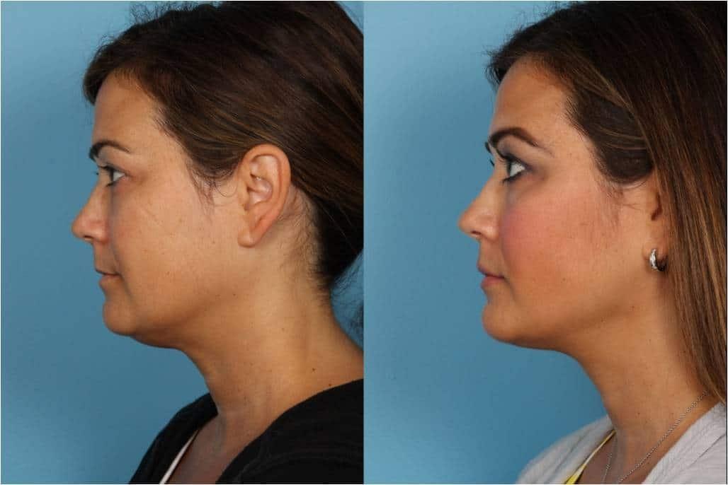 Douglas M. Sidle, MD neck liposuction result — Chicago, IL