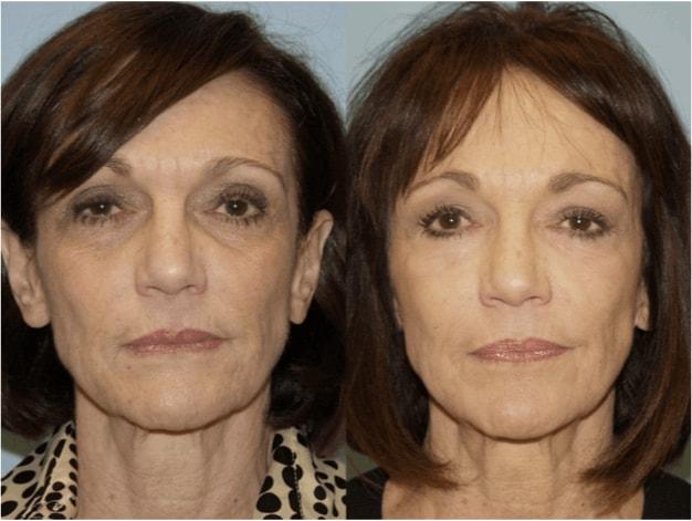 Douglas M. Sidle, MD eyelid lift result — Chicago, IL