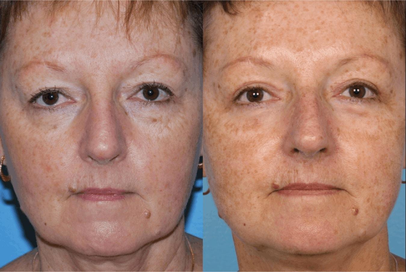 Douglas M. Sidle, MD eyelid lift result — Chicago, IL