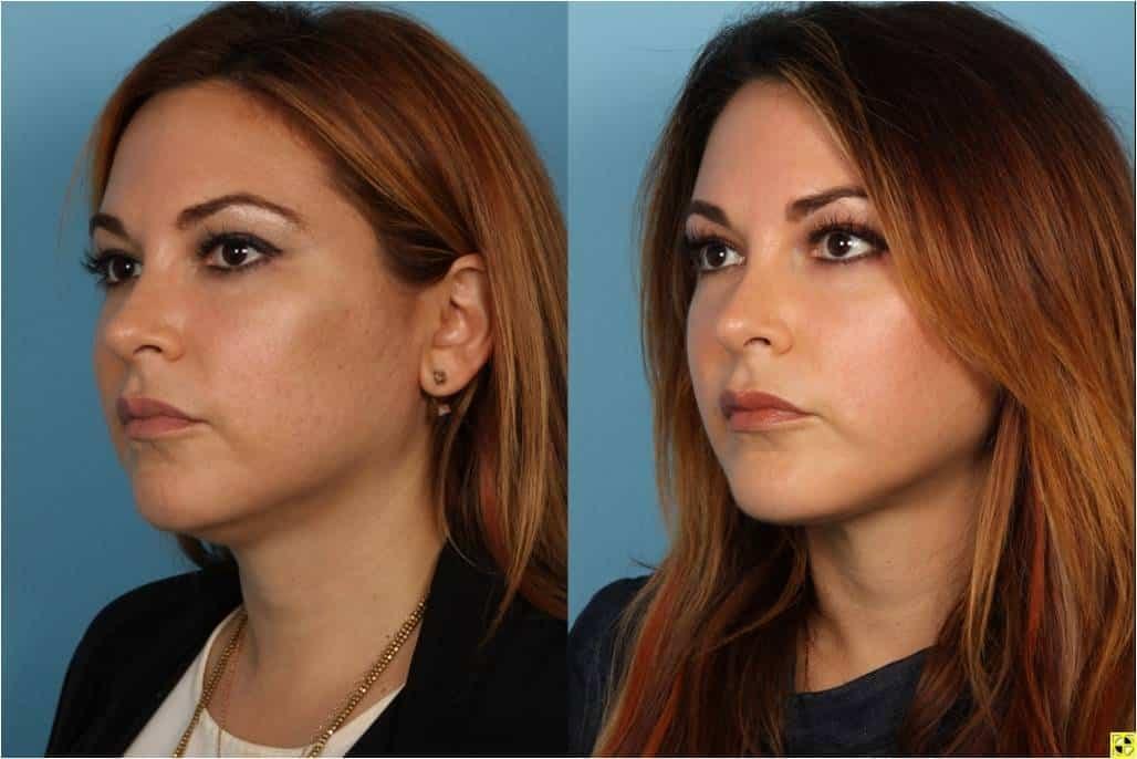 Douglas M. Sidle, MD neck liposuction result — Chicago, IL