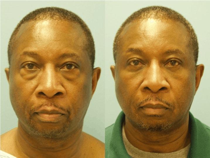 Douglas M. Sidle, MD eyelid lift result — Chicago, IL