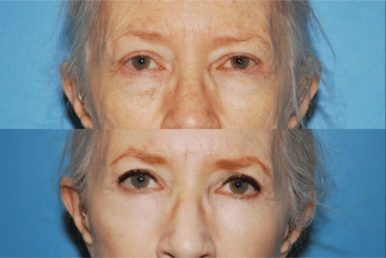 Douglas M. Sidle, MD eyelid lift result — Chicago, IL