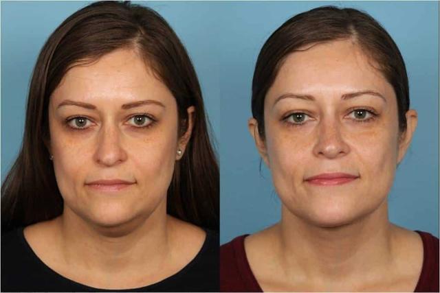 Neck Liposuction result at Douglas M. Sidle, MD in Chicago, IL