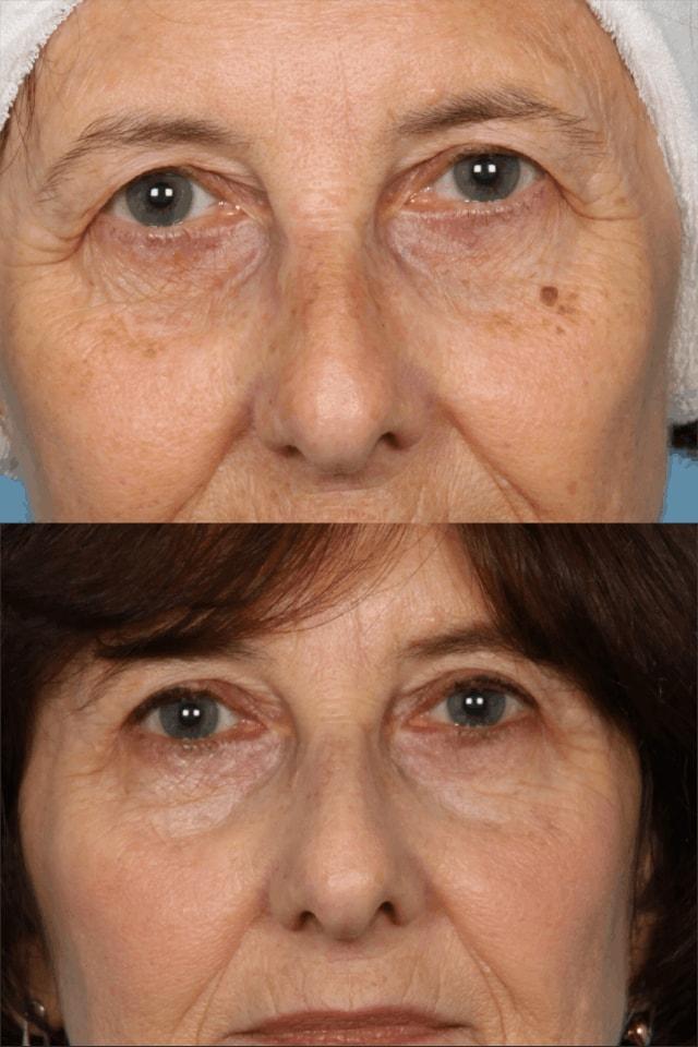 Douglas M. Sidle, MD eyelid lift result — Chicago, IL