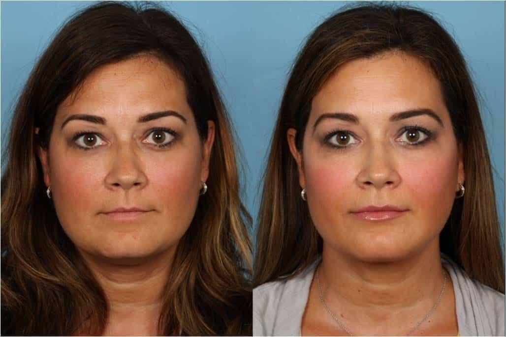 Douglas M. Sidle, MD neck liposuction result — Chicago, IL