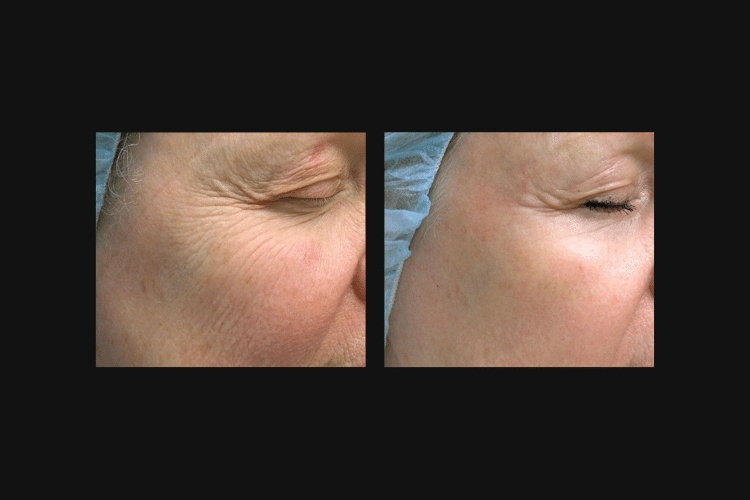 Bright Esthetics & Body Wellness botox result — Manchester, NH