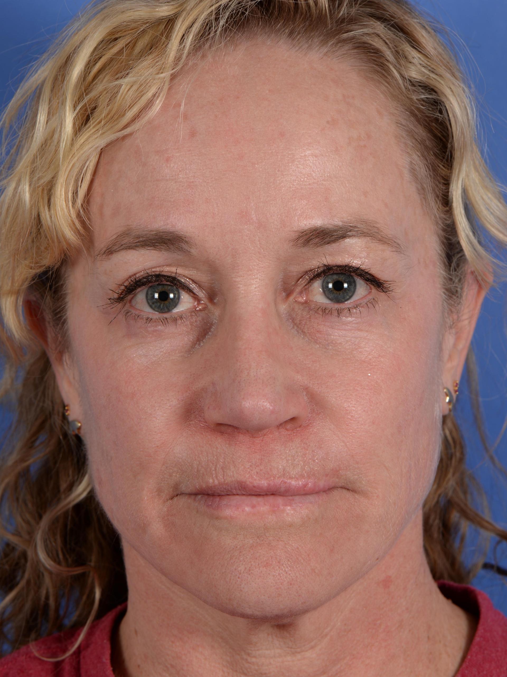 Colorado Facial Plastic Surgery rhinoplasty after — Englewood, CO