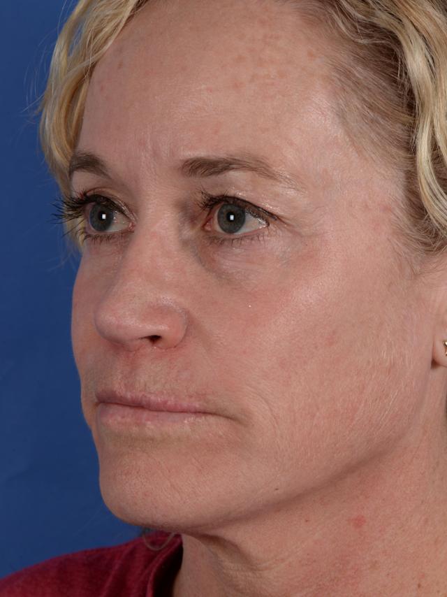 Ethnic Rhinoplasty after at Colorado Facial Plastic Surgery in Englewood, CO