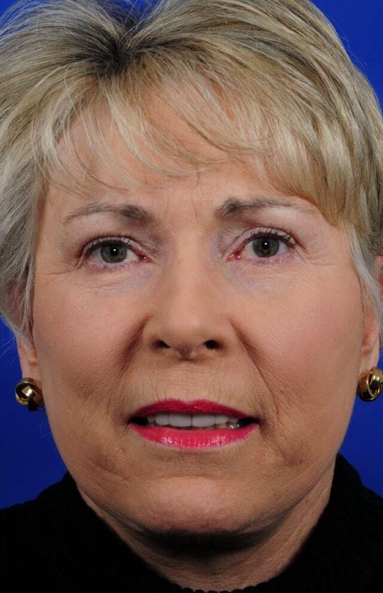Colorado Facial Plastic Surgery eyelid lift after — Englewood, CO