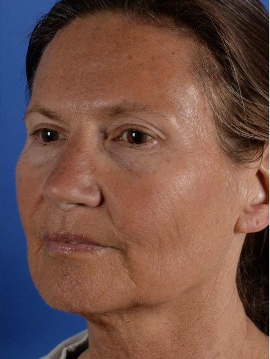 Colorado Facial Plastic Surgery eyelid lift after — Englewood, CO