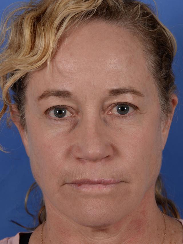 Ethnic Rhinoplasty before at Colorado Facial Plastic Surgery in Englewood, CO