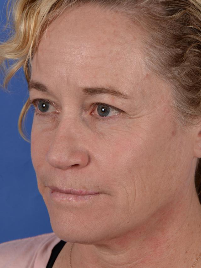Ethnic Rhinoplasty before at Colorado Facial Plastic Surgery in Englewood, CO
