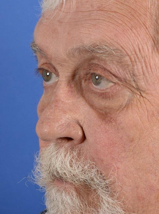 Colorado Facial Plastic Surgery eyelid lift after — Englewood, CO