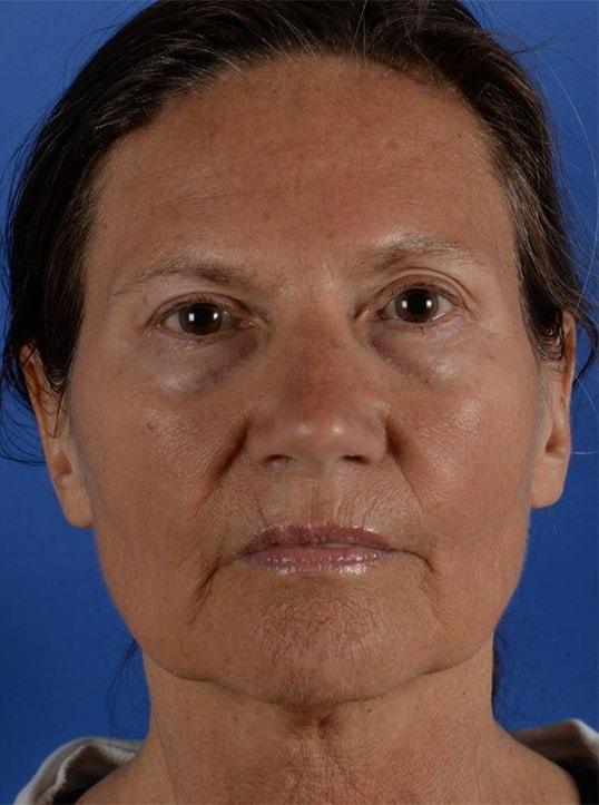 Colorado Facial Plastic Surgery eyelid lift after — Englewood, CO