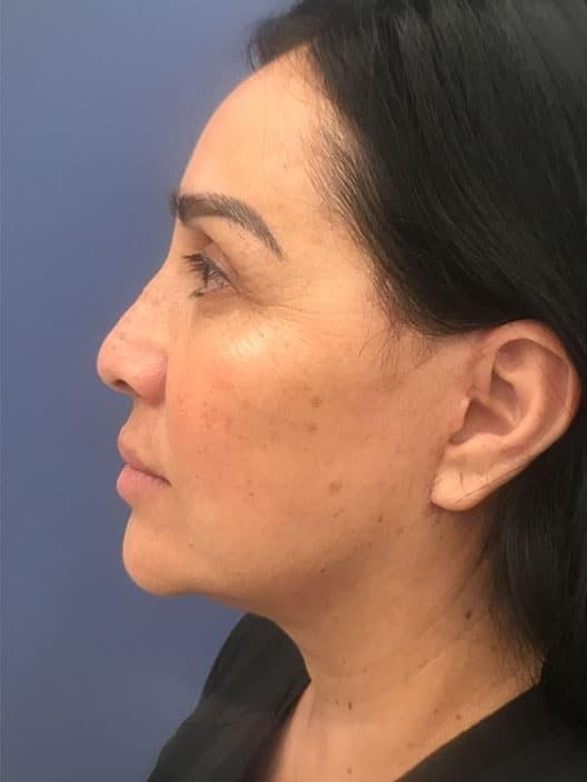 S. Daniel Golshani, MD facelift after — Beverly Hills, CA