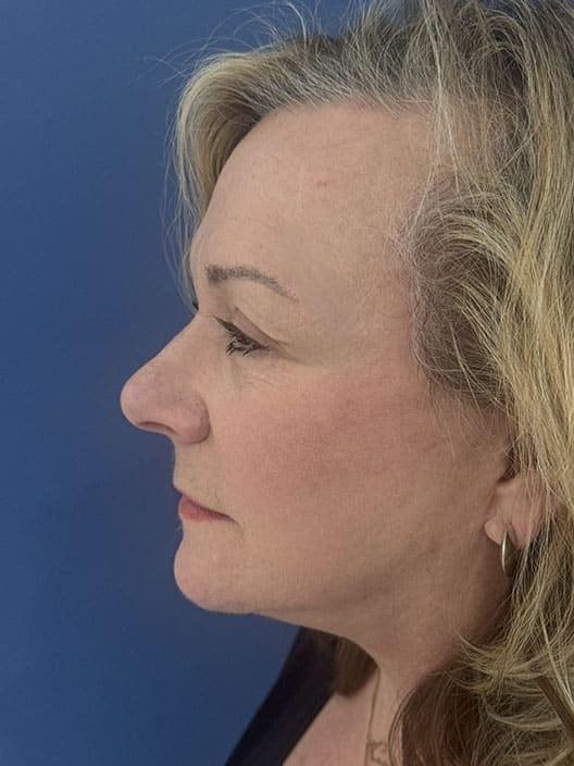 S. Daniel Golshani, MD facelift after — Beverly Hills, CA