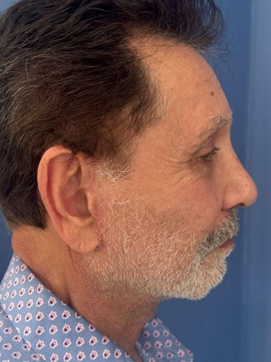 S. Daniel Golshani, MD facelift after — Beverly Hills, CA