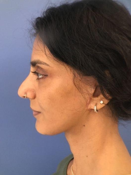 S. Daniel Golshani, MD facelift after — Beverly Hills, CA