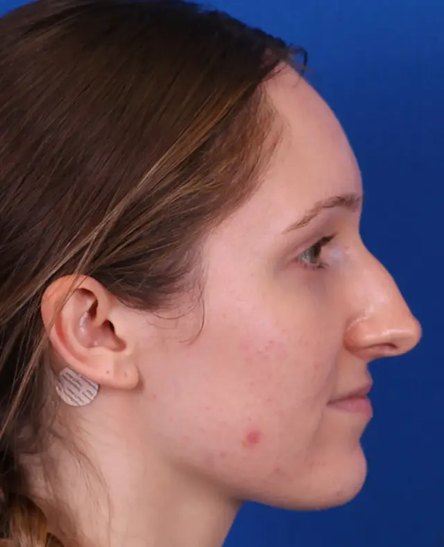 Functional Rhinoplasty before at Omaha Face & Body in Elkhorn, NE