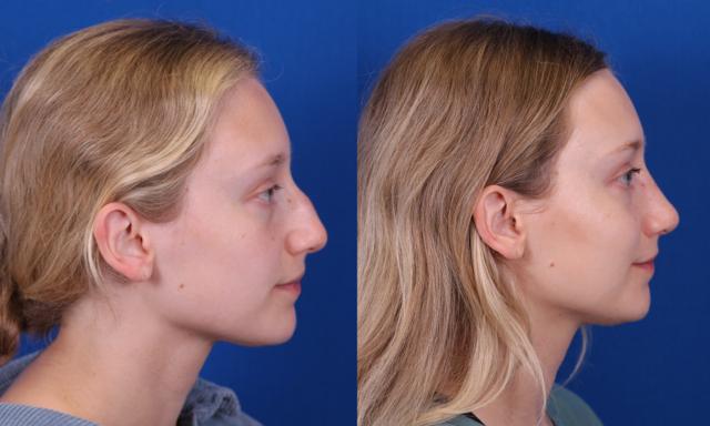 Rhinoplasty result at Omaha Face & Body in Elkhorn, NE