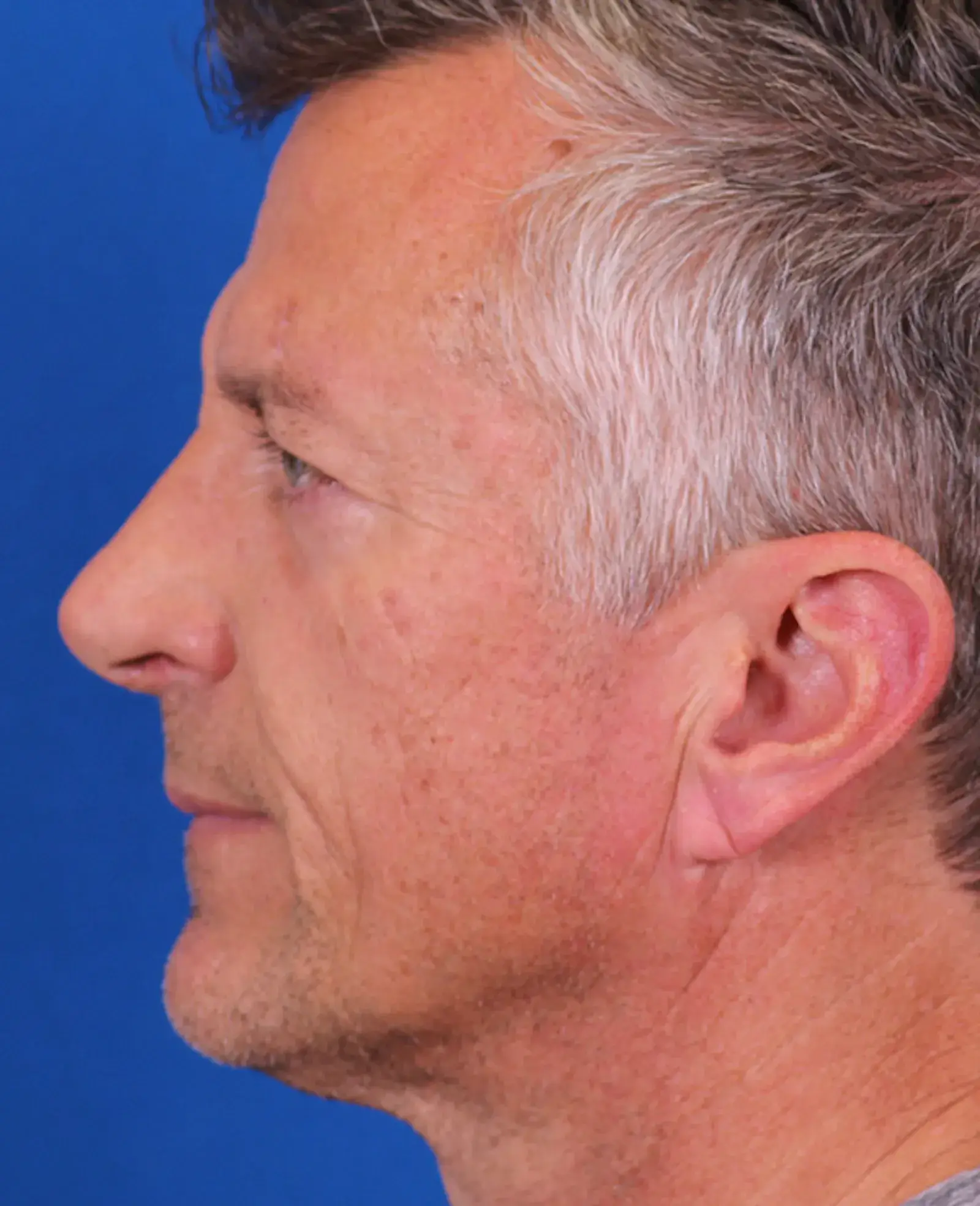 Omaha Face & Body rhinoplasty after — Elkhorn, NE