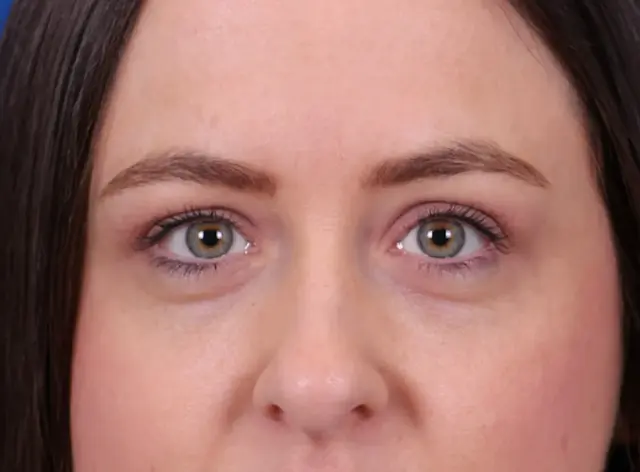 Blepharoplasty after at Omaha Face & Body in Elkhorn, NE