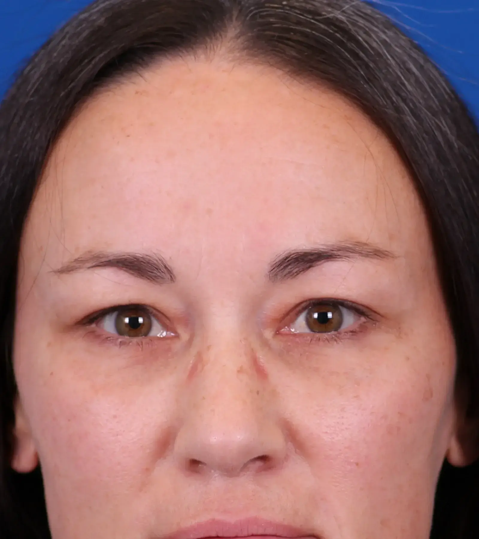Omaha Face & Body eyelid lift after — Elkhorn, NE