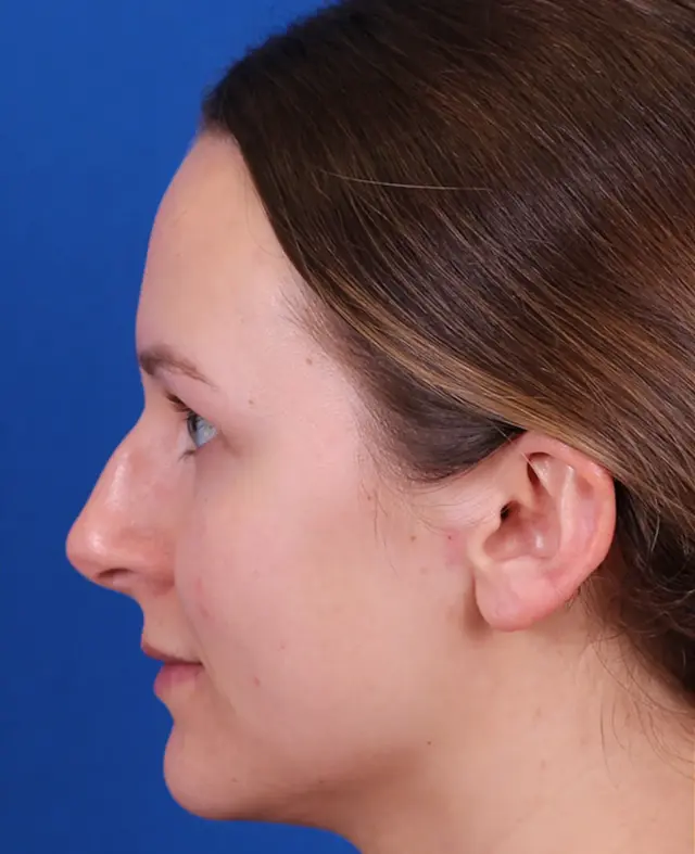 Functional Rhinoplasty before at Omaha Face & Body in Elkhorn, NE