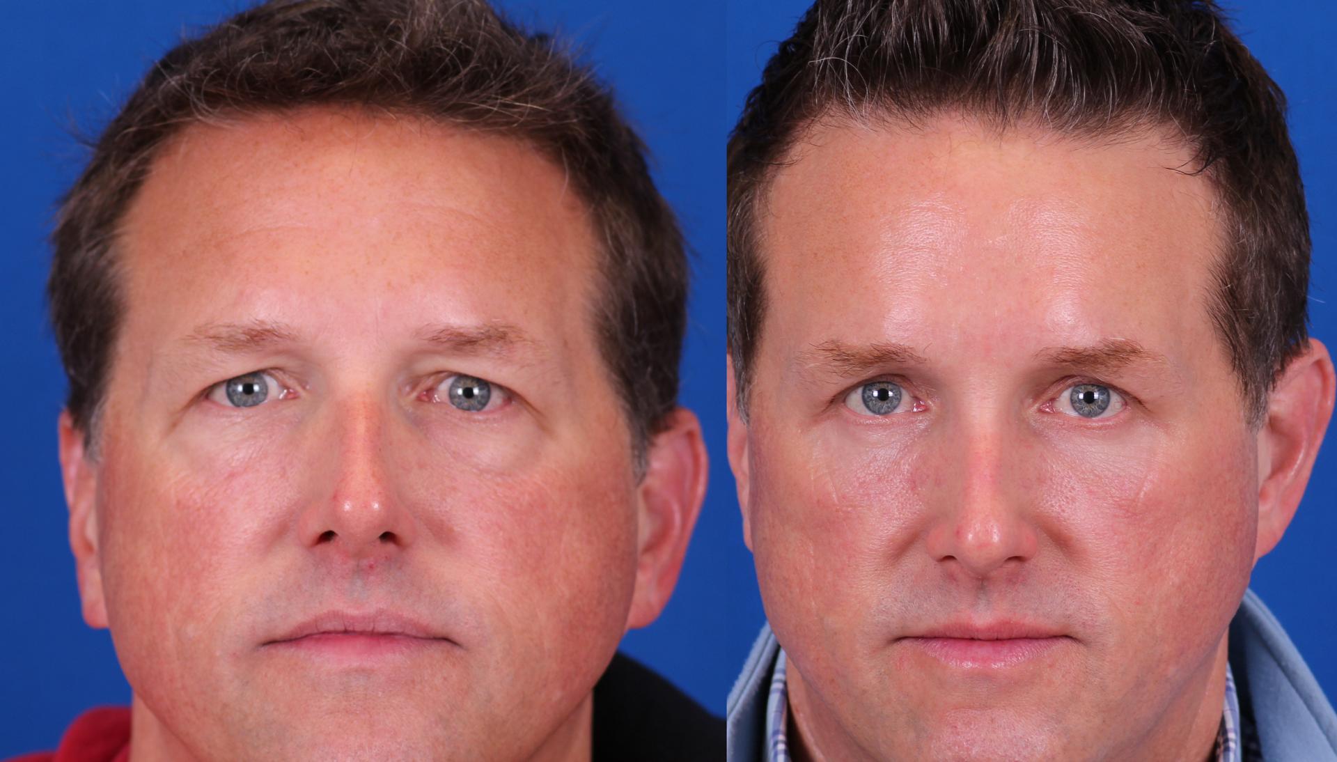 Omaha Face & Body eyelid lift result — Elkhorn, NE