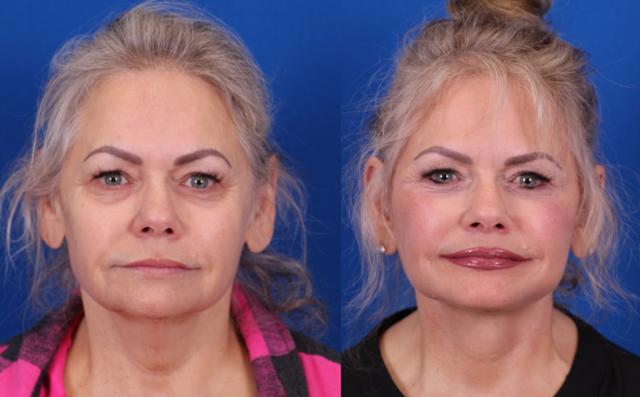Mini Facelift result at Omaha Face & Body in Elkhorn, NE