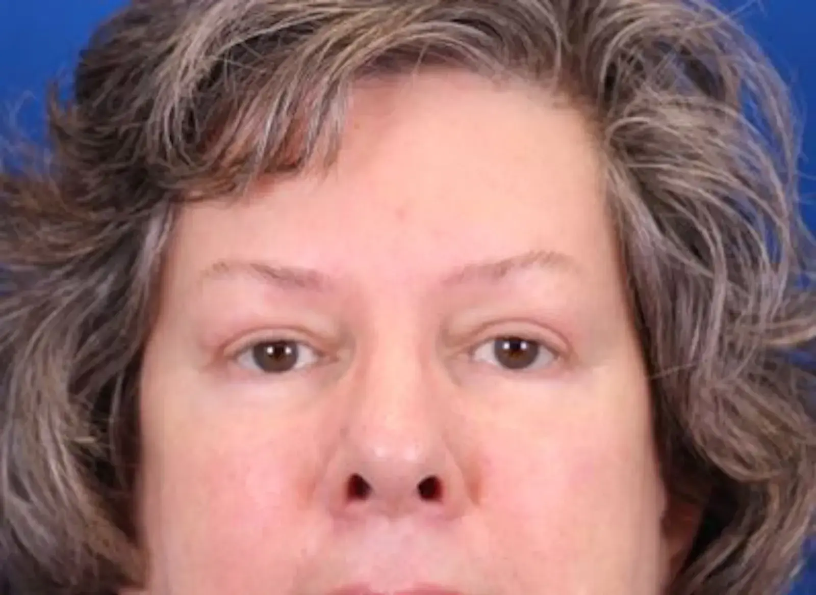 Omaha Face & Body eyelid lift after — Elkhorn, NE