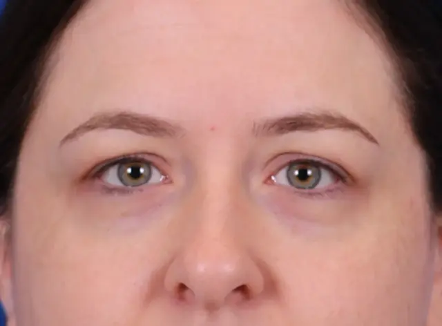 Blepharoplasty before at Omaha Face & Body in Elkhorn, NE