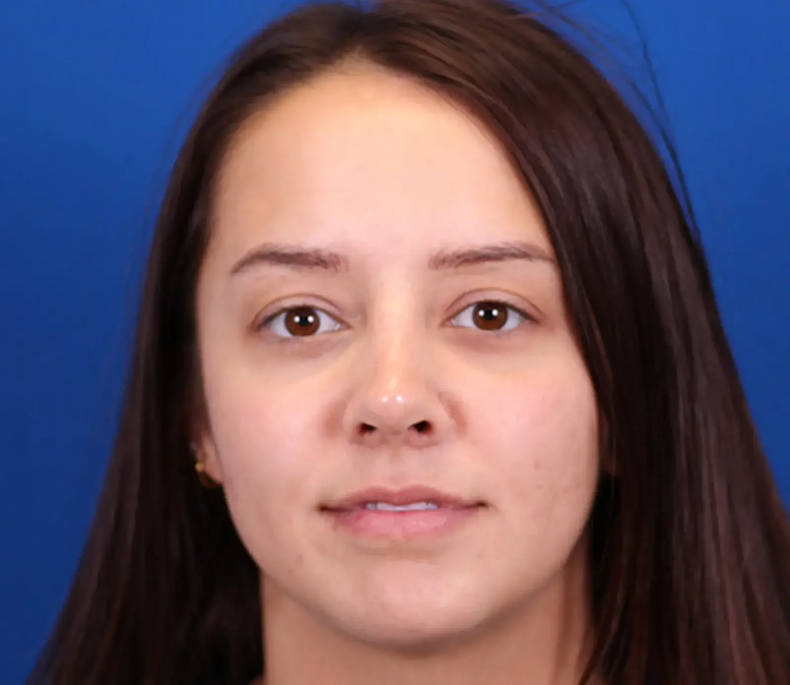 Omaha Face & Body rhinoplasty after — Elkhorn, NE