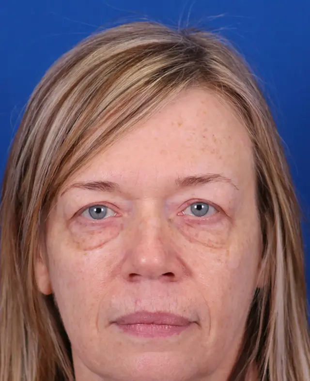 Blepharoplasty before at Omaha Face & Body in Elkhorn, NE